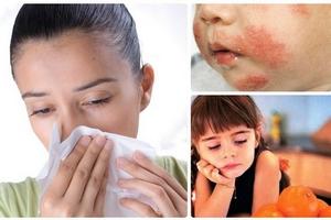 Аллергияның симптомдары